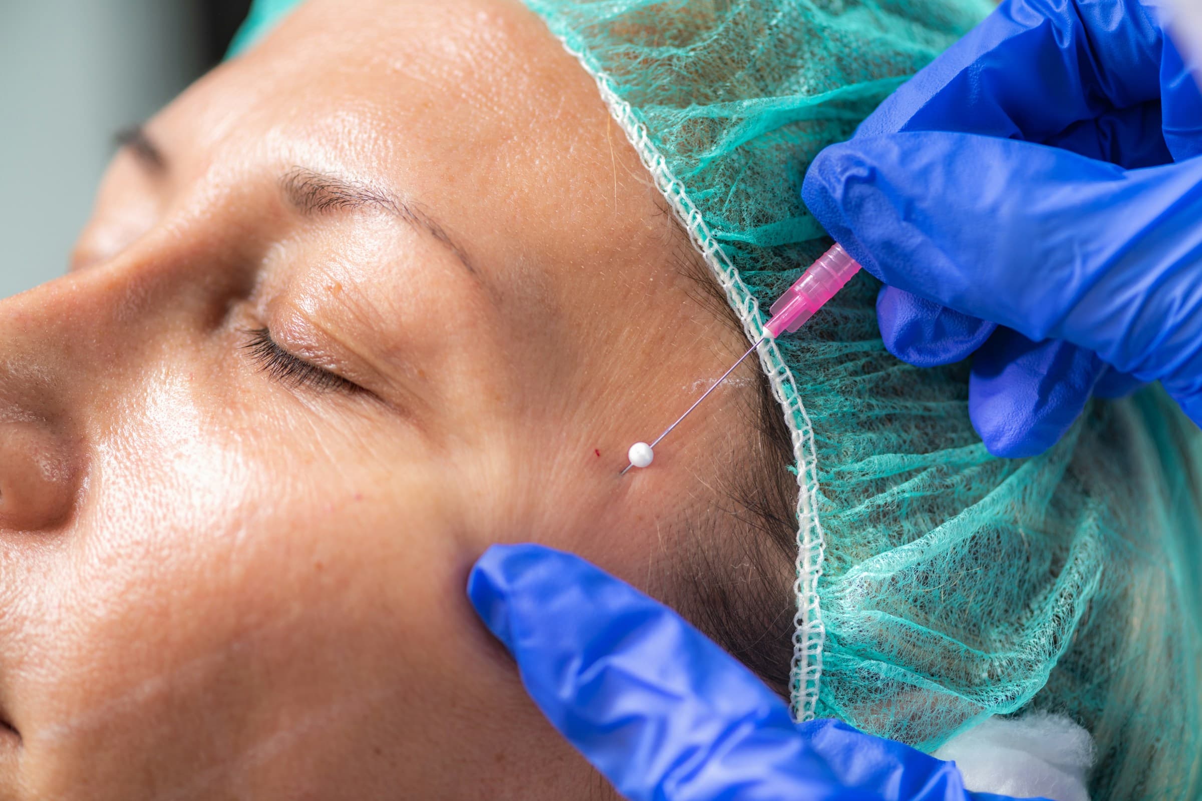 Microneedling promo